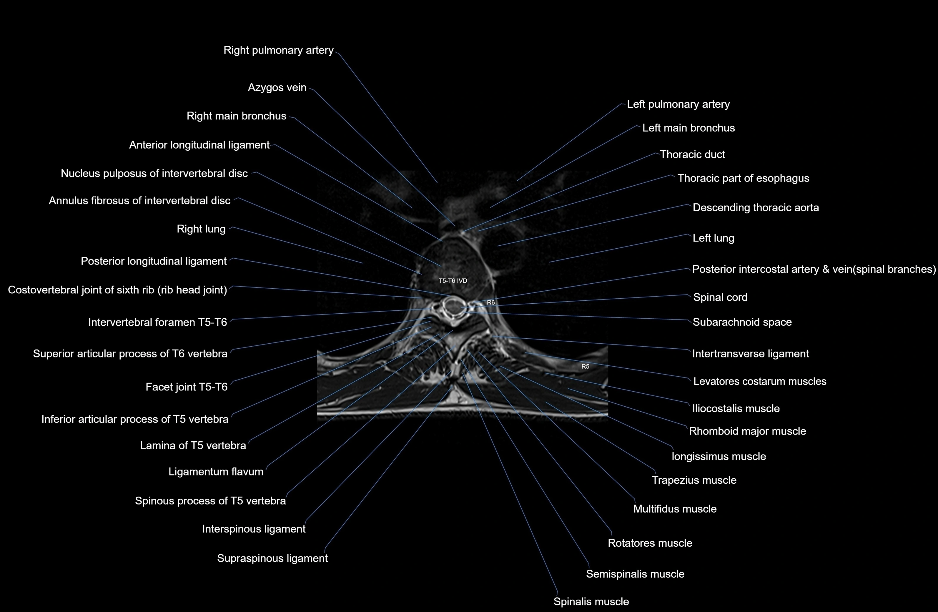 MRI thoracic spine axial  cross sectional anatomy 3T radiology  image-img-00001-00035.webp